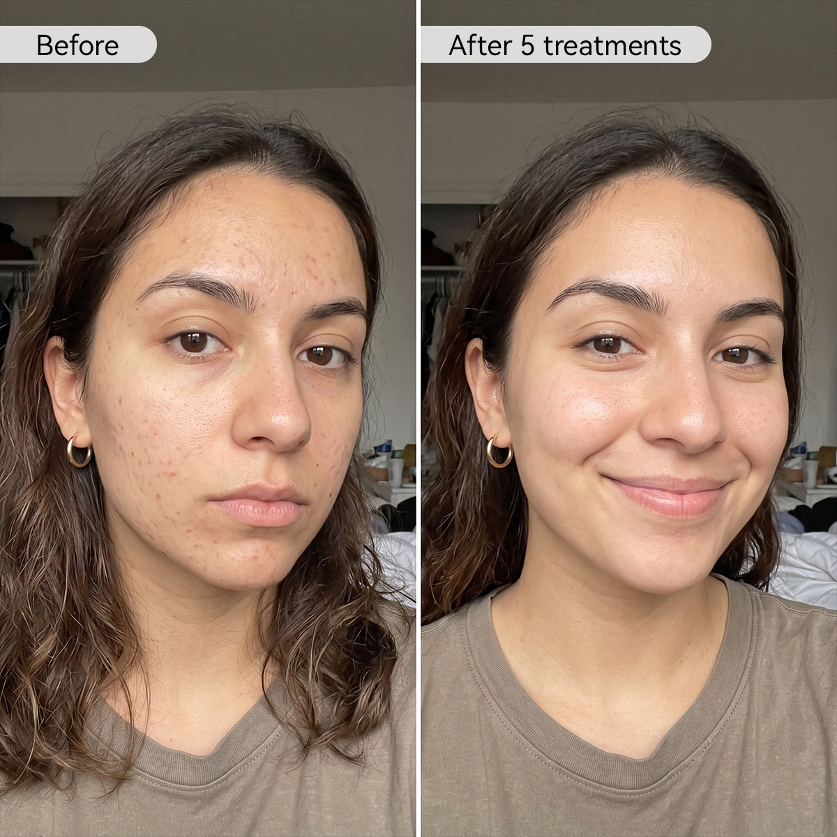 PDRN Advanced Infusion Treatment