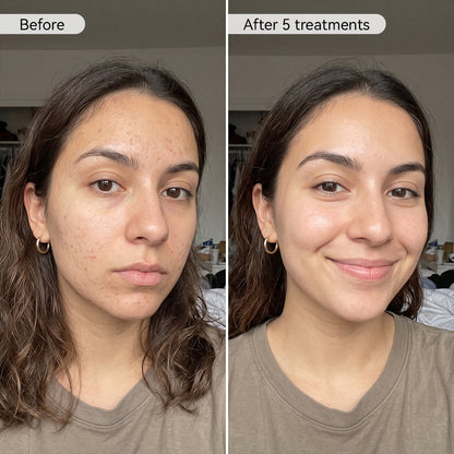 PDRN Advanced Infusion Treatment
