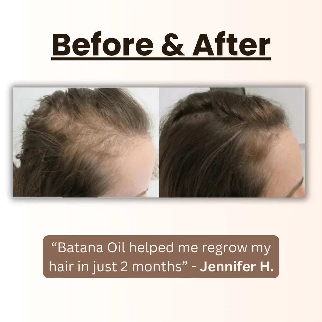💯【Official Brand Store】- 🌿Natural Herbal Handcrafted Batana Oil Hair Growth Blend