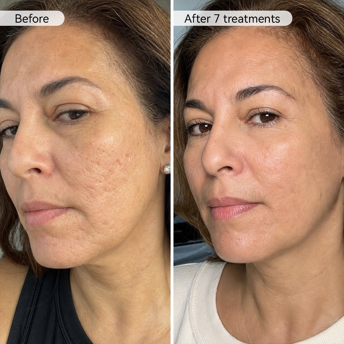 PDRN Advanced Infusion Treatment