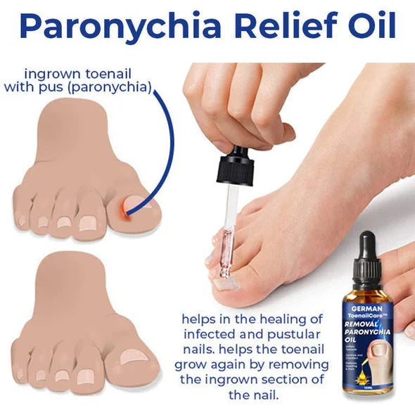 Ateticime Removal Paronychia