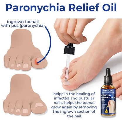 Ateticime Removal Paronychia