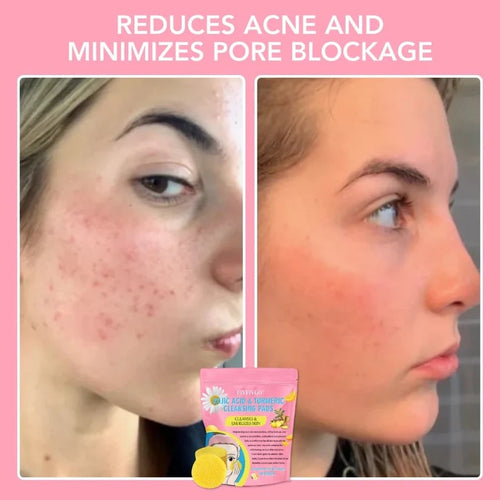 🔥LAST DAY 49% OFF🔥 Turmeric Kojic Acid Cleansing Pads
