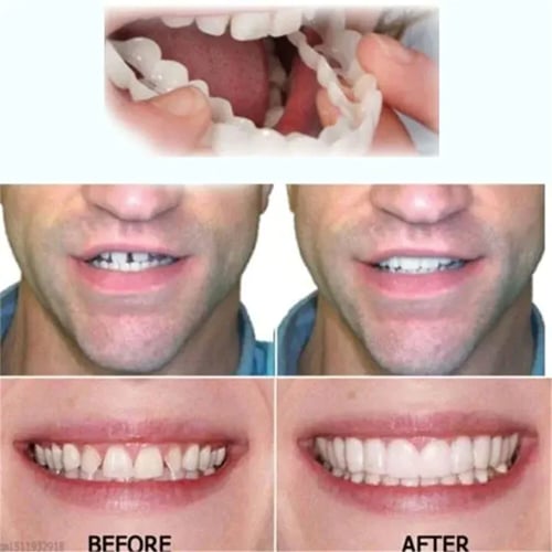 Official Brand Store - Eeihoe™Adjustable Snap-On Dentures