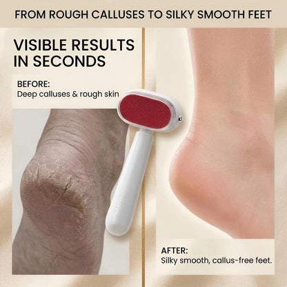 Foot Callus Remover