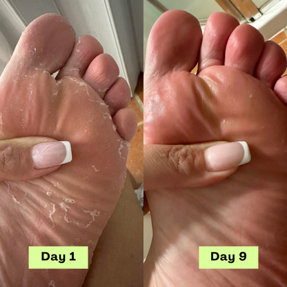 AntiFungal Relief Soap Bar