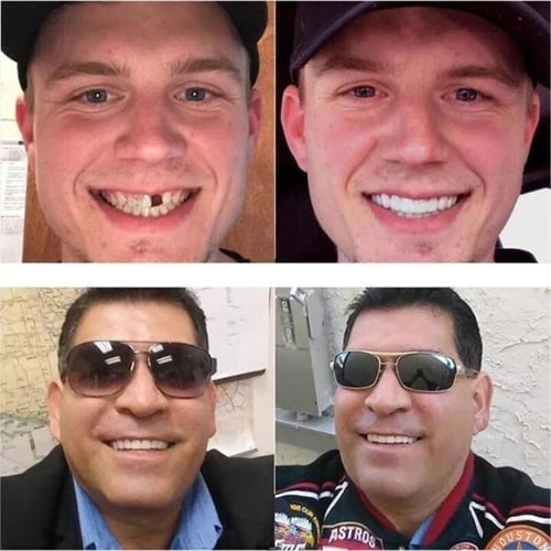 Official Brand Store - Eeihoe™Adjustable Snap-On Dentures