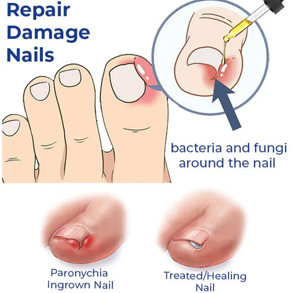 Ateticime Removal Paronychia